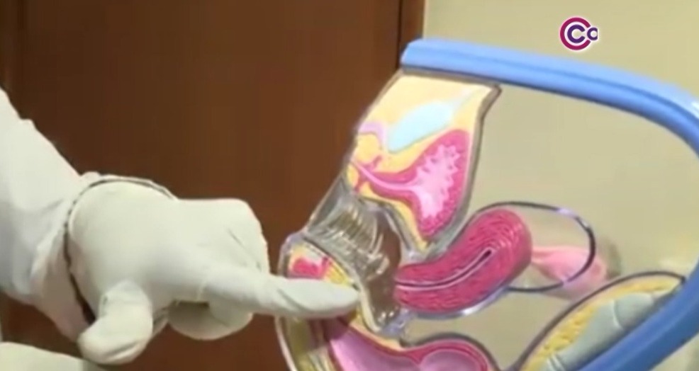 Intensifica Sector Salud acciones de prevención de cáncer cérvico uterino