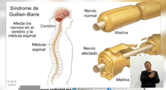 Tlaxcala tiene 26 casos confirmados del síndrome de Guillain Barré